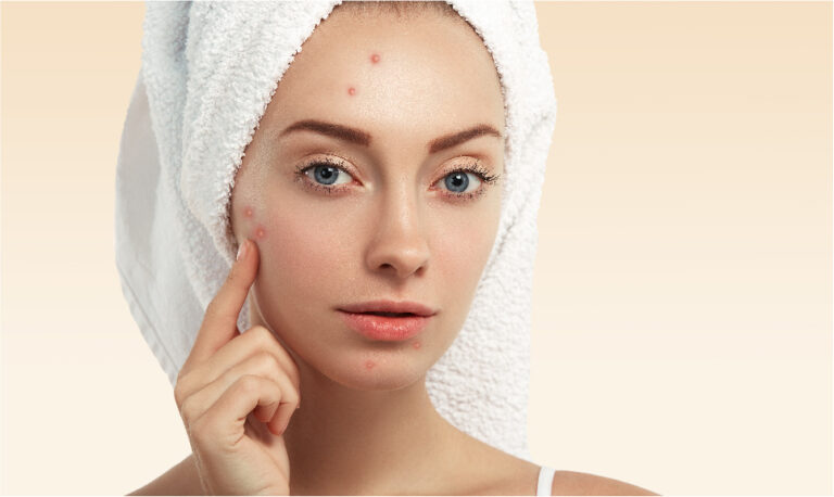 Acne Explained: Causes, Triggers, and How to Build a Clear Skin Routine